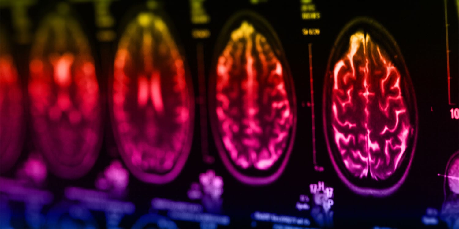 研究：AI识别出四种偏头痛表型