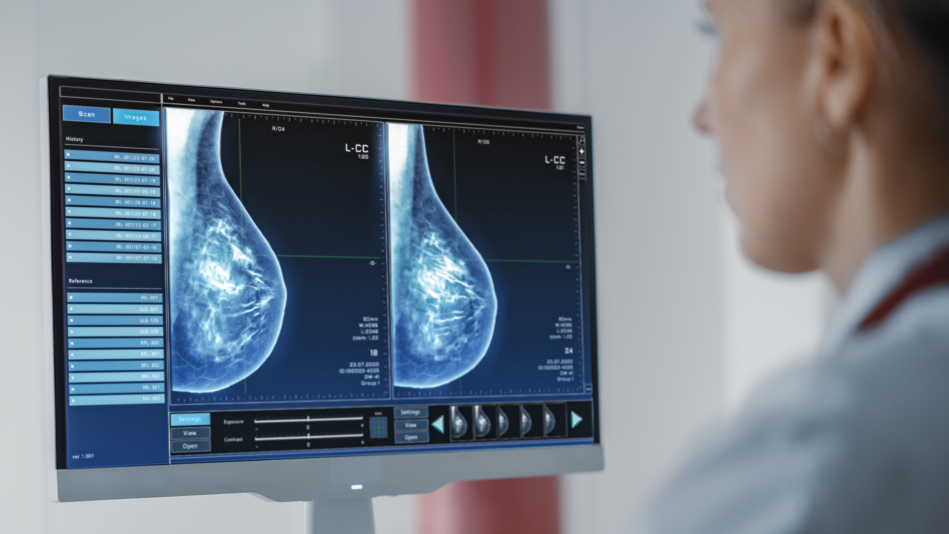 英伟达生态初创用AI弥补乳腺癌诊疗缺口